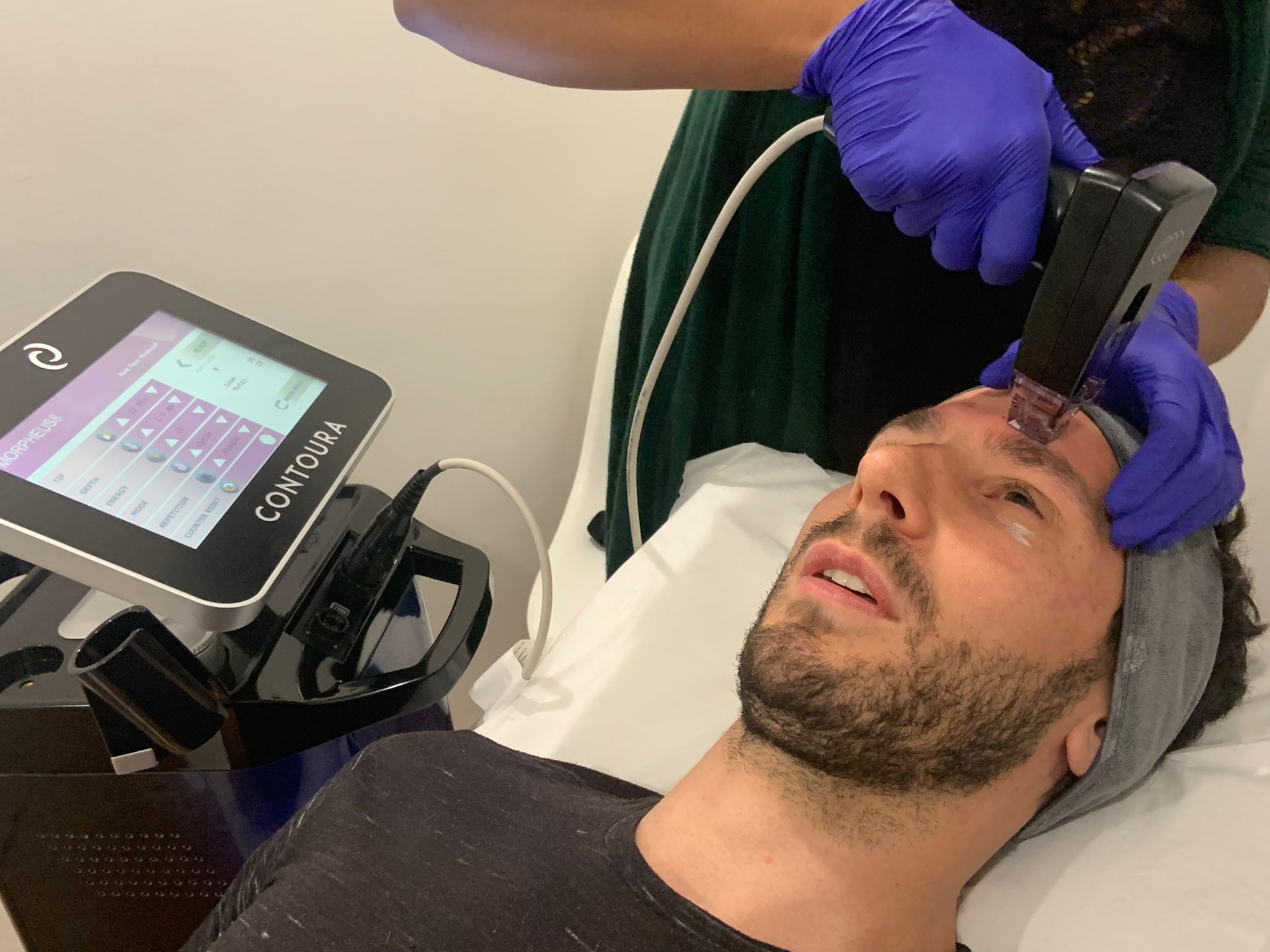 Morepheus8 treatment on male in Caterham, Surrey