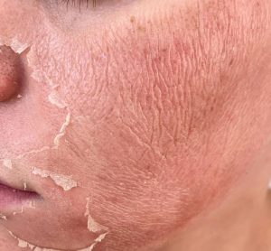 Chemical Peel revocery caterham