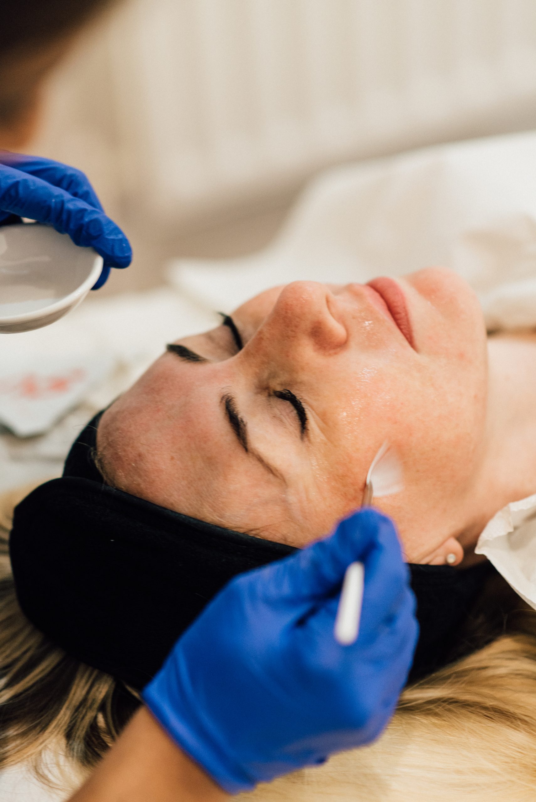 Chemical Peel Guide – Medium or Deep Options Explained
