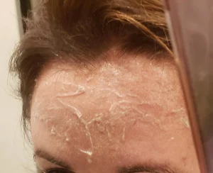 chemical peel recovery 2 Surrey