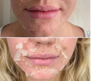 chemical peel recovery surrey