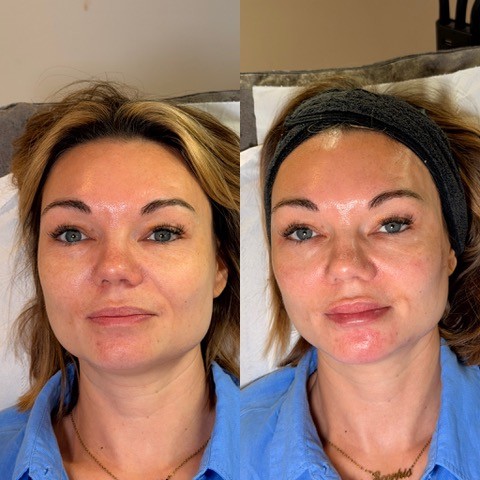 How Much Does Facial Harmonisation (Full Face Filler) Cost? A Surrey Patient's Guide 1 image 2 1