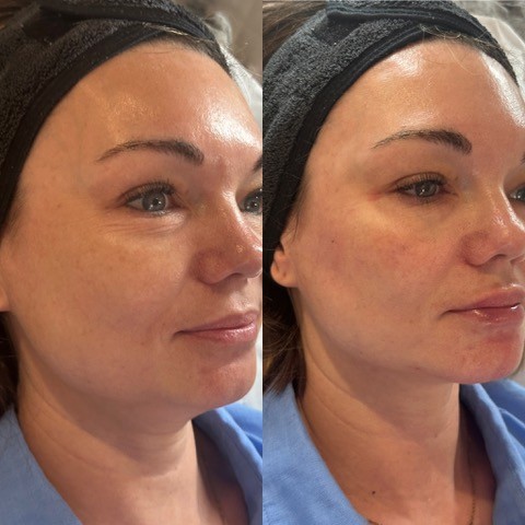 How Much Does Facial Harmonisation (Full Face Filler) Cost? A Surrey Patient's Guide 2 image 3