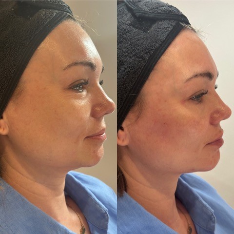How Much Does Facial Harmonisation (Full Face Filler) Cost? A Surrey Patient's Guide 3 image 4