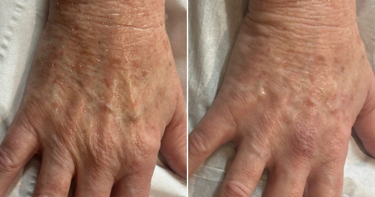 Hyperdilute Radiesse Before and After: Realistic Results, Timeline and What to Expect